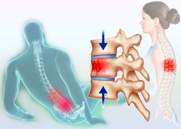 Dokonca aj obyčajné zranenie môže vyvolať vývoj osteochondrózy