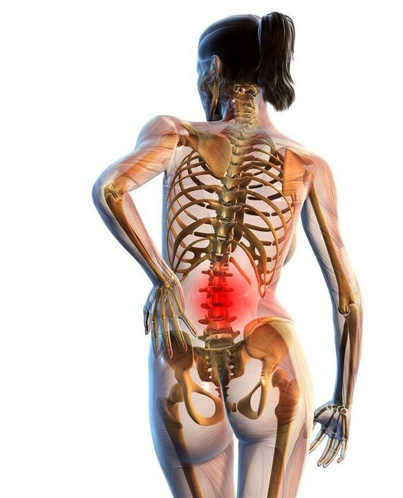 Najčastejšie sa vyskytuje osteochondróza bedrovej chrbtice