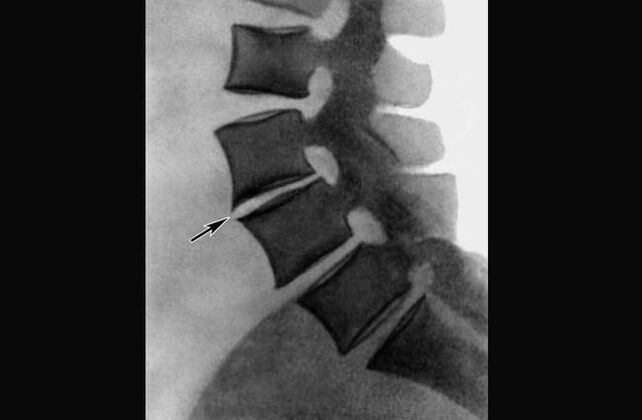 Prejavy osteochondrózy hrudnej chrbtice na röntgenovom snímku